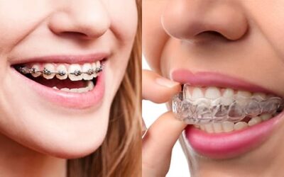 Invisible Aligners vs. Conventional Braces: Exploring Efficiency in Orthodontic Treatment