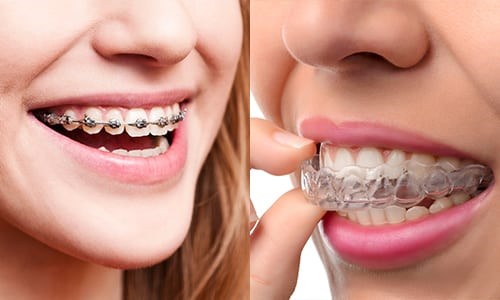 Invisible Aligners vs. Conventional Braces: Exploring Efficiency in Orthodontic Treatment