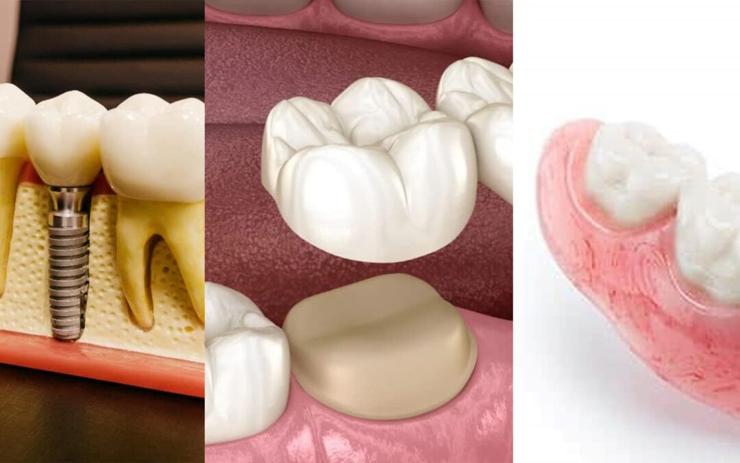 Tooth Replacement Options: Implants vs. Bridges vs. Dentures – A Comprehensive Guide by Tooth and Braces Dental Clinic Kolkata